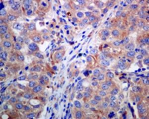 Immunohistochemical analysis of paraffin-embedded, formalin-fixed breast carcinoma tissue, staining BIVM using ab137113 at a 1/50 dilution.