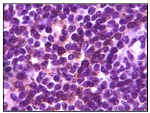 Ab47700 staining human BLK in human lymph tissue, showing membrane localization, with DAB staining.