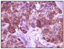Ab47700 staining human BLK in human skin carcinoma, showing membrane localization, with DAB staining.