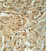 Immunohistochemical analysis of formalin-fixed paraffin-embedded Human cervix carcinoma tissue labeling BLOC1S2 using ab174929 at 1/50 dilution followed by peroxidase conjugation of the secondary antibody and DAB staining.