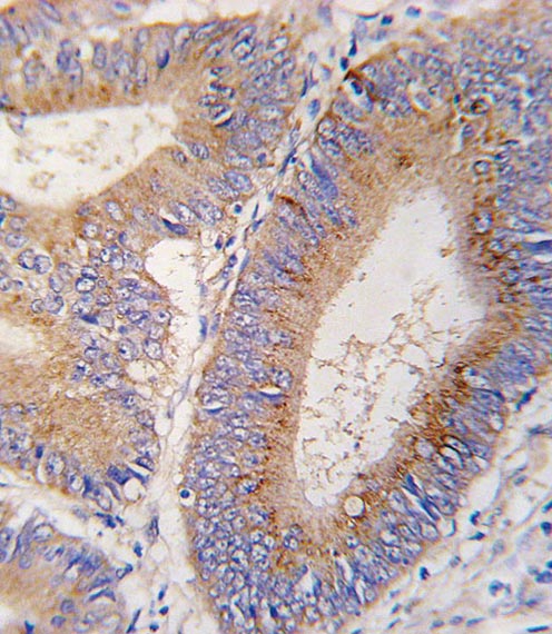 Immunohistochemistry (Formalin/PFA-fixed paraffin-embedded sections) analysis of human colon carcinoma tissue labelling BMP11 with ab71347. Tissue was fixed with formaldehyde and blocked with 3% BSA for 0.5 hour at 38°C; antigen retrieval was by heat mediation with a citrate buffer (pH6). Samples were incubated with primary antibody (1/25) for 1 hour at 37°C. A peroxidase-conjugated goat anti-rabbit polyclonal (ready to use) was used as the secondary antibody.