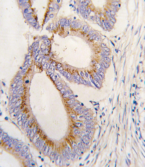 Immunohistochemistry (Formalin/PFA-fixed paraffin-embedded sections) analysis of human colon carcinoma tissue labelling BMP11 with ab71347. Tissue was fixed with formaldehyde and blocked with 3% BSA for 0.5 hour at 38°C; antigen retrieval was by heat mediation with a citrate buffer (pH6). Samples were incubated with primary antibody (1/25) for 1 hour at 37°C. A peroxidase-conjugated goat anti-rabbit polyclonal (ready to use) was used as the secondary antibody.
