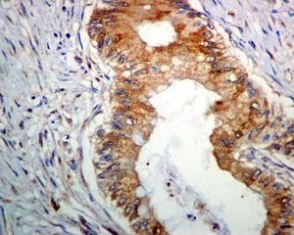 Immunohistochemistry (Formalin/PFA-fixed paraffin-embedded sections) analysis of human colon adenocarcinoma tissue labelling BMP11 with unpurified ab124721 at 1/500 dilution.