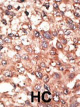 Ab38565 staining human BMP5 in human cancer tissue by immunohistochemistry using formalin fixed paraffin embedded tissue. The primary antibody was peroxidase-conjugated to the secondary antibody, followed by AEC staining. BC = breast carcinoma HC = hepatocarcinoma.