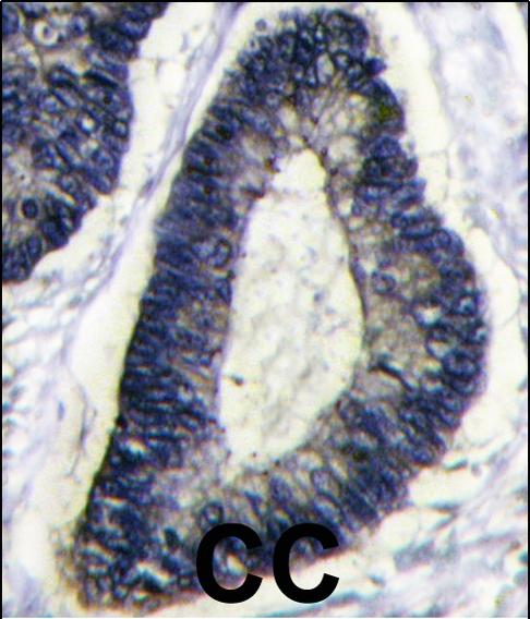 This image shows human colon carcinoma stained with ab38621 at 5ug/200ul dilution.