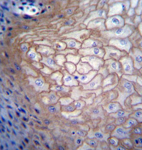 Immunohistochemical analysis of formalin-fixed, paraffin-embedded Human esophageal carcinoma tissue labeling Borealin/CDCA8 with ab171148 at 1/10 dilution, followed by peroxidase conjugation of the secondary antibody and DAB staining.