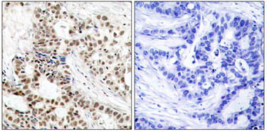 ab47325 staining human breast carcinoma tissue by IHC-P (left hand panel). The right hand panel shows staining in the presence of phospho-peptide.ab47325 staining human breast carcinoma tissue by IHC-P (left hand panel). The right hand panel shows staining in the presence of phospho-peptide.
