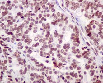 Immunohistochemical analysis of paraffin-embedded Human ovarian cancer tissue labeling BTF with ab181240 at 1/100 dilution followed by prediluted HRP Polymer for Rabbit IgG. Counter stained with hematoxylin.