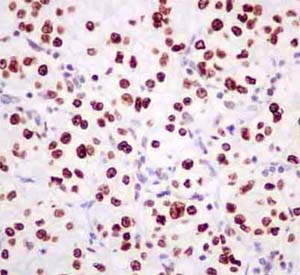 Immunohistochemical analysis of paraffin-embedded Human kidney cell carcinoma labeling BXDC1 with ab180604 at 1/50 dilution, followed by prediluted ImmunoHistoprobe (Ready to use) HRP Polymer for Rabbit IgG. Counter stained with Hematoxylin.
