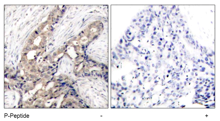 ab47315 staining human breast carcinoma by IHC-P (left hand panel). The right hand panel shows staining in the presence of phospho-peptide.