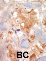 ab5505 staining c-Kit in human breast carcinoma (BC) tissue by Immunohistochemistry (Formalin/PFA-fixed paraffin-embedded sections).