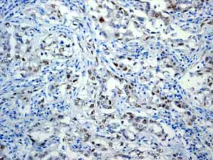 Immunohistochemistry (Formalin/PFA-fixed paraffin-embedded sections) analysis of human gastric adenocarcinoma tissue labelling c-Myc with unpurified ab32072.