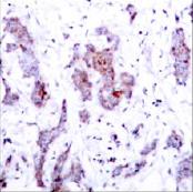 ab31413 at 1/50, staining human c-Rel in paraffin embedded human breast carcinoma tissue using immunohistochemistry.