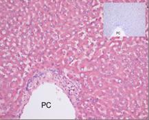 ab81707, at a dilution of 1/50, staining paraffin embedded human liver melanoma cells by Immunohistochemistry. Insert is isotype control.