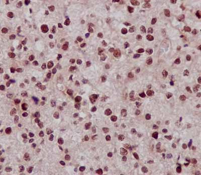 Immunohistochemical analysis of paraffin-embedded human astrocytoma tissue labeling C14orf166 using ab188326 at 1/100 dilution. A ready to use HRP polymer for rabbit IgG (prediluted) was used as secondary. Counterstain: Hematoxylin.