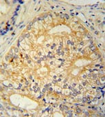 ab107610, at 1/50 dilution, staining C16orf13 in formalin fixed, paraffin embedded Human prostate carcinoma by Immunohistochemistry, using a peroxidase conjugated secondary antibody and DAB staining.