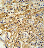 ab104301, at 1/50 dilution, staining C16orf61 in formalin-fixed, paraffin-embedded Human breast carcinoma by Immunohistochemistry using a peroxidase conjugated secondary antibody and DAB staining.