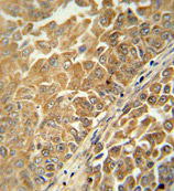 ab107064 at 1/50 dilution staining C18orf25 in Formalin-fixed, Paraffin-embedded Human bladder carcinoma tissue by Immunohistochemistry followed by peroxidase-conjugated secondary antibody and DAB staining.