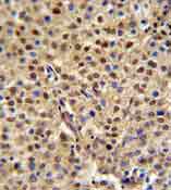 Immunohistochemical analysis of formalin fixed and paraffin embedded Human cervix carcinoma labeling C19orf21 with ab175101 at 1/50 dilution followed by peroxidase conjugation of the secondary antibody and DAB staining.