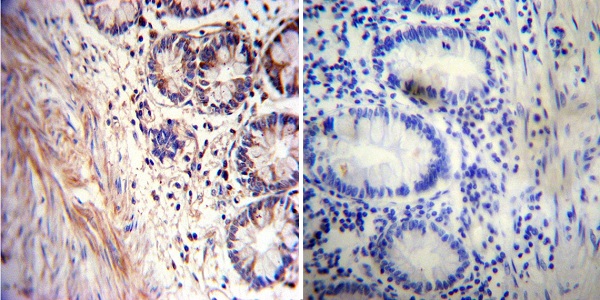 Immunohistochemistry was performed on both normal and cancer biopsies of deparaffinized human Rectum tissue. To expose target proteins, heat induced antigen retrieval was performed using 10mM sodium citrate (pH6.0) buffer, microwaved for 8-15 minutes. Following antigen retrieval tissues were blocked in 3% BSA-PBS for 30 minutes at room temperature. Tissues were then probed at a dilution of 1:20 with a mouse monoclonal antibody recognizing Acetylcholinesterase (ab2803) or without primary antibody (negative control) overnight at 4°C in a humidified chamber. Tissues were washed extensively with PBST and endogenous peroxidase activity was quenched with a peroxidase suppressor. Detection was performed using a biotin-conjugated secondary antibody and SA-HRP, followed by colorimetric detection using DAB. Tissues were counterstained with hematoxylin and prepped for mounting.