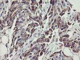 Immunohistochemical analysis of paraffin embedded Human breast adenocarcinoma tissue labeling C1ORF151 with ab150339 at 1/150.