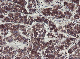 Immunohistochemical analysis of paraffin embedded Human liver carcinoma tissue labeling C1ORF151 with ab150339 at 1/150.