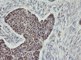 Immunohistochemical analysis of paraffin embedded Human lung carcinoma tissue labeling C1ORF151 with ab150339 at 1/150.