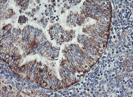 Immunohistochemical analysis of paraffin embedded Human endometrium adenocarcinoma tissue labeling C1ORF151 with ab150339 at 1/150.
