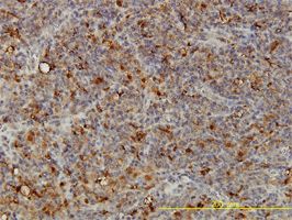 Acid Phosphatase 2 antibody (ab54721) used in immunohistochemistry at 5ug/ml on formalin fixed and paraffin embedded human lymphoma tissue.
