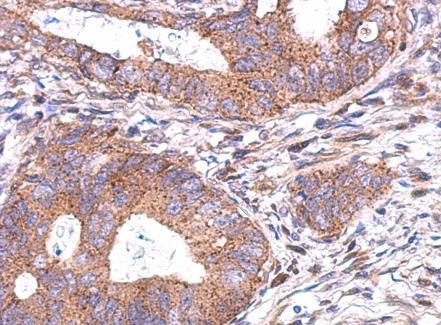 Immunohistochemical analysis of paraffin-embedded Human gastric cancer tissue labeling C20orf7 with ab155208 at 1/500 dilution.