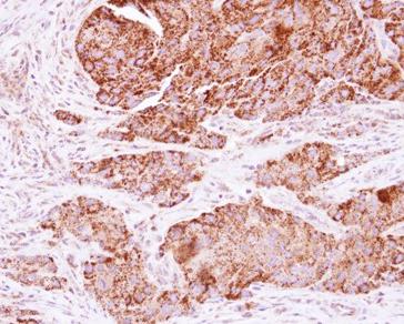 ab125694, at 1/250 dilution, staining C21orf33 in Formalin-fixed, Paraffin-embedded Human colon cancer tissue by Immunohistochemistry.