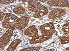ab126250, at 1/500 dilution, staining paraffin-embedded colon ca by immunohistochemical analysis