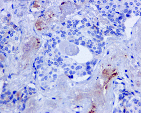 ab170942 showing +ve staining in Human thyroid gland carcinoma tissue.