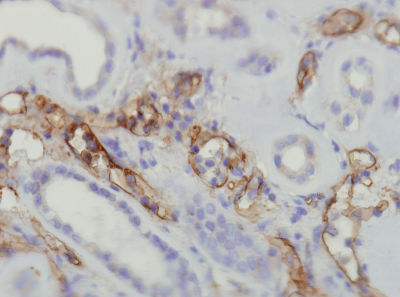 Immunohistochemical analysis of formalin-fixed, paraffin-embedded Human transplanted kidney tissue labelling C4d with ab136921 at 1/100 dilution showing diffuse strong positive immunostaining of dilated peritubular moderate capillaries indicating acute antibody mediated rejection.