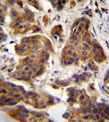 Immunohistochemistry analysis of formalin-fixed paraffin-embedded Human bladder carcinoma labeling C4orf21 with ab170344 at 1/50, followed by peroxidase conjugation of the secondary antibody and DAB staining.
