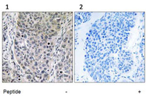 ab92646 at 1/50 dilution staining C8orf30A in (1) Human lung carcinoma minus blocking peptide and (2) Human lung carcinoma plus blocking peptide by Immunohistochemistry Formalin-fixed, Paraffin-embedded tissue.