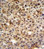 ab103744, at 1/50 dilution, staining C9orf174 in formalin-fixed, paraffin-embedded Human cervix carcinoma tissue by Immunohistochemistry using a peroxidase conjugated secondary antibody and DAB staining.