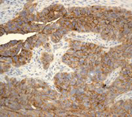 ab110640 at 1/100 dilution staining CA 125 in Human serous carcinoma by Immunohistochemistry, Paraffin-embedded tissue.