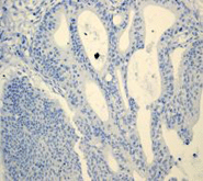 ab110640 at 1/100 dilution staining CA 125 in Human mucinous carcinoma by Immunohistochemistry, Paraffin-embedded tissue.