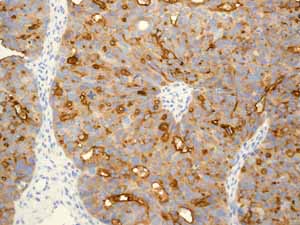ab110640 showing positive staining in Serous ovarian carcinoma tissue.