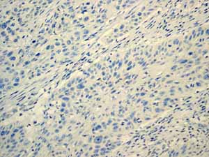 ab110640 showing negative staining in Cervical carcinoma tissue.