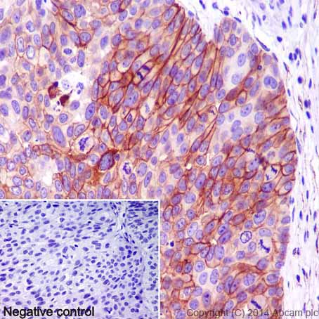 Immunohistochemical analysis of paraffin-embedded Human bladder transitional cell carcinoma tissue labeling CA12 with ab195233 at 1/100 dilution followed by Goat Anti-Rabbit IgG H&L (HRP) (ab97051) at 1/500 dilution and counter-stained with Hematoxylin. (inset: negative control).Note: Cell membrane and weakly cytoplasm staining on human transitional cell carcinoma of bladder tissue was observed.