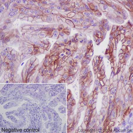 Immunohistochemical analysis of paraffin-embedded Human ovarian carcinoma tissue labeling CA12 with ab195233 at 1/100 dilution followed by Goat Anti-Rabbit IgG H&L (HRP) (ab97051) at 1/500 dilution and counter-stained with Hematoxylin. (inset: negative control).Note: Cell membrane and weakly cytoplasm staining on human ovarian carcinoma tissue was observed.