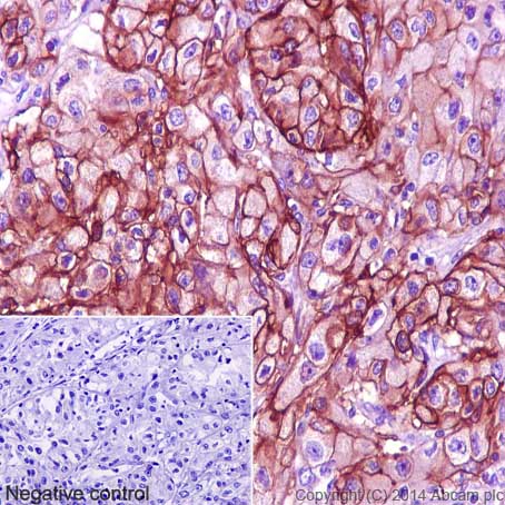 Immunohistochemical analysis of paraffin-embedded Human renal adenocarcinoma tissue labeling CA12 with ab195233 at 1/100 dilution followed by Goat Anti-Rabbit IgG H&L (HRP) (ab97051) at 1/500 dilution and counter-stained with Hematoxylin. (inset: negative control).Note: Cell membrane and cytoplasm staining on human renal adenocarcinoma tissue was observed.