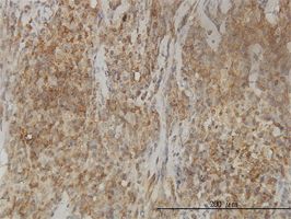 CAB39L antibody (ab57880) used in immunohistochemistry at 3ug/ml on formalin fixed and paraffin embedded human lymphoma tissue.