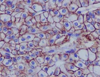 Immunohistochemical analysis of paraffin-embedded Human chromophobe renal cell carcinoma tissue labeling Cadherin 16 with ab183745 at 1/4000 dilution followed by prediluted HRP Polymer for Rabbit IgG. Counter stained with hematoxylin.