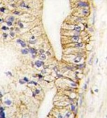 Immunohistochemistry of formalin-fixed, paraffin-embedded Human prostata carcinoma tissue labeling Cadherin 7 with ab189965 at 10 µg/ml.