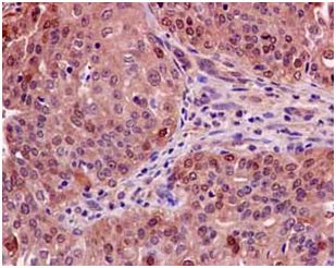 Immunohistochemical analysis of paraffin-embedded Human endometrial adenocarcinoma tissue labeling calcyphosine with ab186741 at 1/4000 dilution. The slide is counterstained with Hematoxylin.