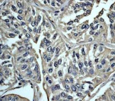 Ab45689 (1:250) staining human Calmodulin in human urinary bladder carcinoma by immunohistochemistry in paraffin embedded tissue.