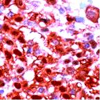Ab27603, prediluted, staining Calretinin in formalin fixed paraffin embedded human mesothelioma tissue sections by Immunohistochemistry.